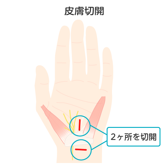 皮膚切開