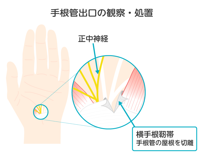 手根管出口の観察・処置
